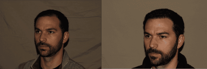Hair Transplant Philadelphia Before and After