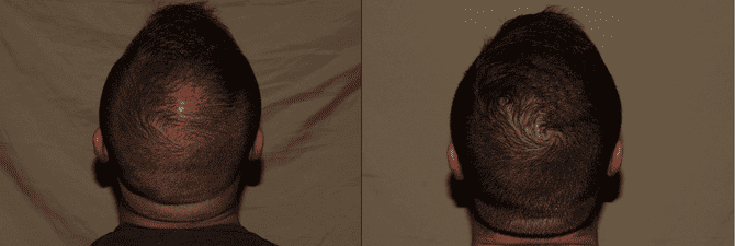 Hair Transplant Philadelphia Before and After