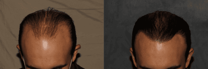 Hair Transplant for Men Philadelphia, PA