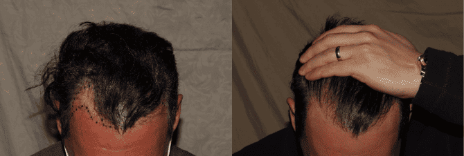 Hair Transplant process