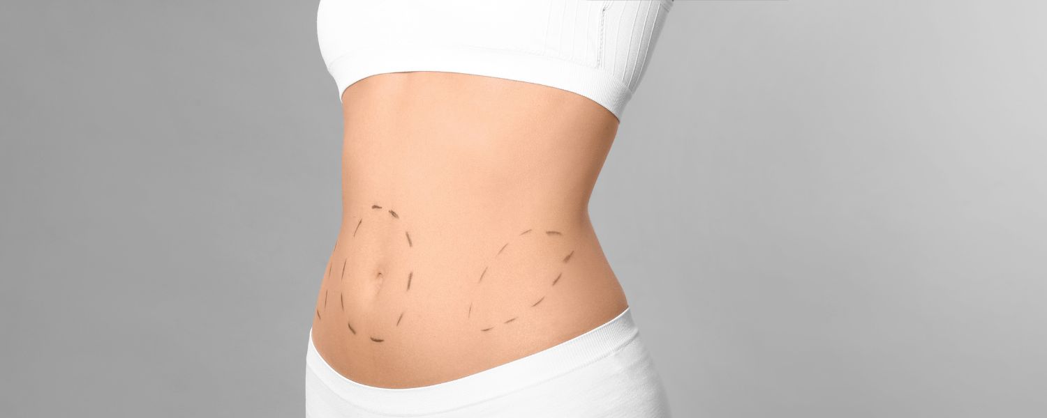 Aesthetic Vision Matters in Liposuction